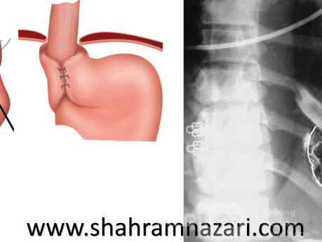 Barium Meal After Nissen Fundoplication
