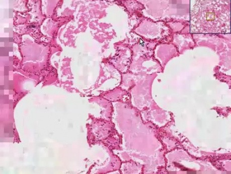 Acute pulmonary edema, Asbestos bodies - Histopathology of lung