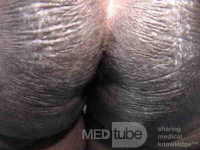 Acanthosis Nigricans (7 of 7)