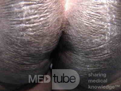 Acanthosis Nigricans (7 of 7)
