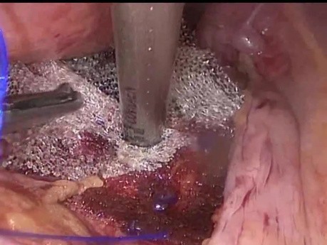 Lasurgeryproscopy Uterine Suspension