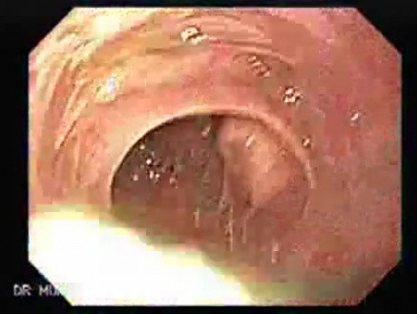 Adenocarcinoma of the Cardias - Closer Look at the Papilla of Vater, Part 1