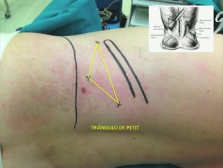 Autotransplantation of Kidney