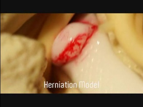 Herniation Model