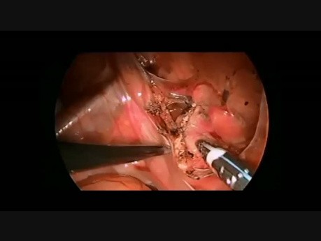 Laparoscopic Resection of the Urachal Cyst in a Child