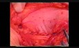 No Mesh Indirect Inguinal Hernia Surgery - Desarda Technique