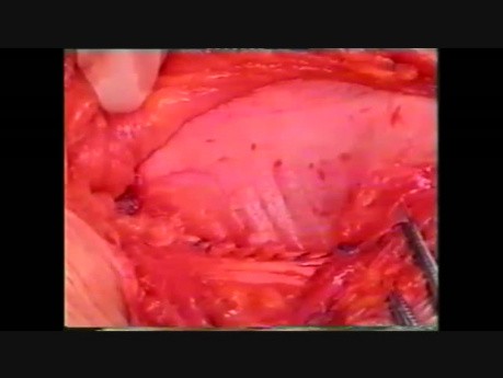 No Mesh Indirect Inguinal Hernia Surgery - Desarda Technique