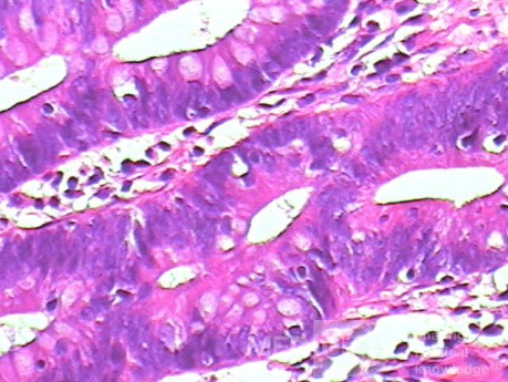 Tubulo - Villous Rectal Adenoma - Endoscopy (29 of 35)
