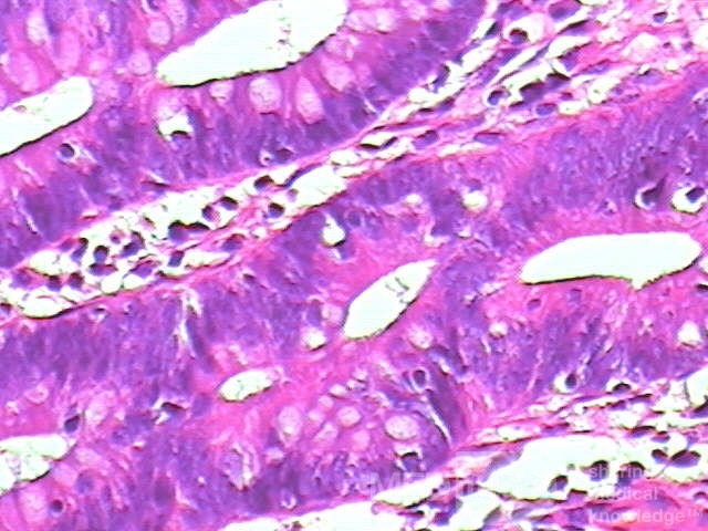Tubulo - Villous Rectal Adenoma - Endoscopy (29 of 35)