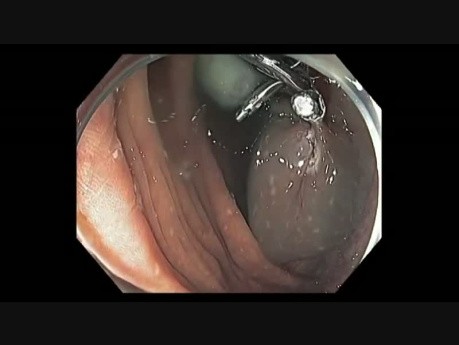 Colonoscopy Channel - EMR Closure (2-4 O'Clock)