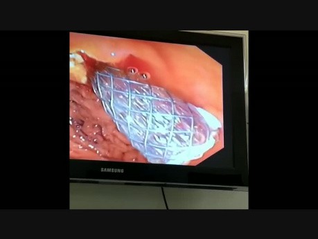 ERCP and Metal Stenting in Hillar Cholangiocarcinoma