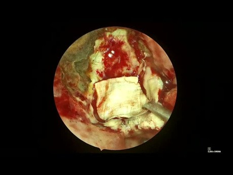 Fat Plug in Repair of CSF Leak 