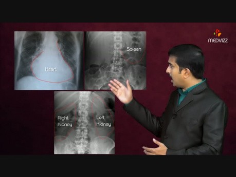 Acromegaly and Gigantism - Usmle Pathology Lecture