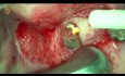 Apicoectomy with YSGG 2780nm Laser