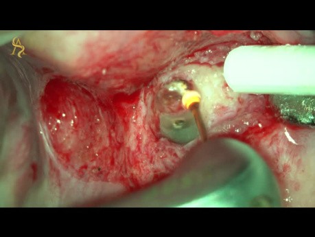 Apicoectomy with YSGG 2780nm Laser