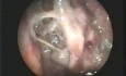 Maggots In Atrophic Rhinits Nose