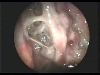 Maggots In Atrophic Rhinits Nose