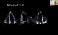 Echocardiography in ﻿Cardio-Oncology