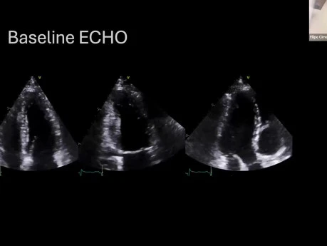 Echocardiography in ﻿Cardio-Oncology