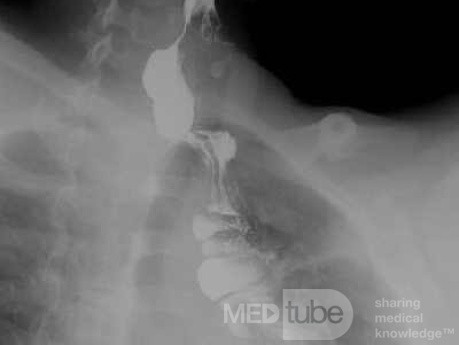 Colonic interposition for Esophageal Substitution (12 of 14)