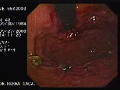 Acute Variceal Bleeding - Two Necrotic Banded Varices