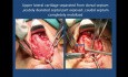 Correction of Caudal Septal Deviation with Nasal Tip Plasty
