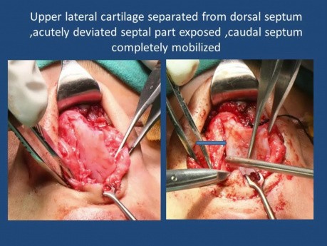 Correction of Caudal Septal Deviation with Nasal Tip Plasty