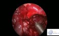 Transmaxillary Approach to Infra Temporal Fossa
