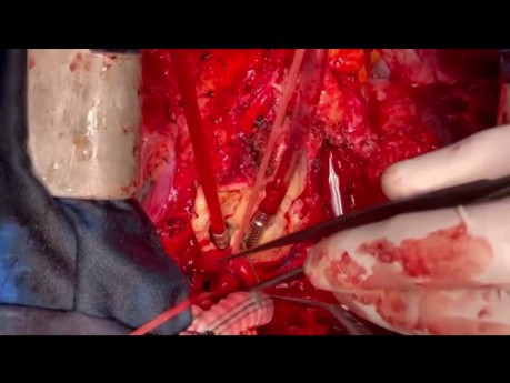 Redo Aortic Surgery Principles from A to Z