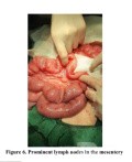 Incomplete Jejunoileal Junction Atresia Chronic Midgut Volvulus