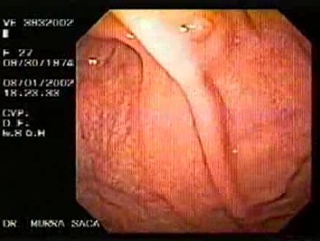 Post Fundoplication Endoscopic Examination (1 of 5)
