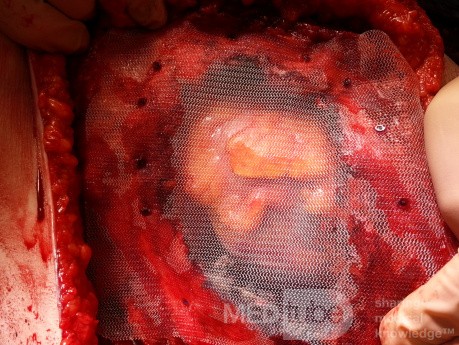 The Defect in the Thoracic Wall Covered with Polypropylene Mesh, Pericardium Left Intact After the Removal of the Liposarcoma of the Left Breast