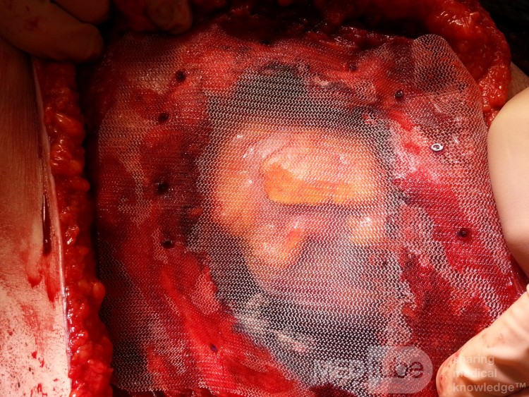 The Defect in the Thoracic Wall Covered with Polypropylene Mesh, Pericardium Left Intact After the Removal of the Liposarcoma of the Left Breast