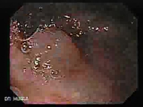 Large Hiatal Hernia - Endoscopy