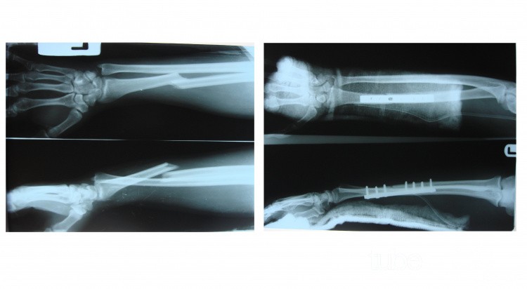 Galiazzi fracture dislocation