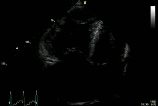 Acute Pulmonary Heart Disease - Thrombus Pulmonary Artery