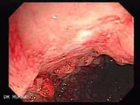 Colitis Ulcerosa - Pseudopolyps (12 of 22)