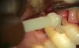 How To Due With An External Root Resorption