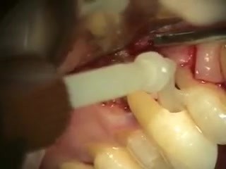 How To Due With An External Root Resorption