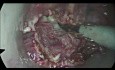 TAMIS for Low Rectal Cancer After RT-CHT