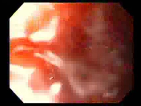 Bleeding Due to Dieulafoy´s Lesion (3 of 8)