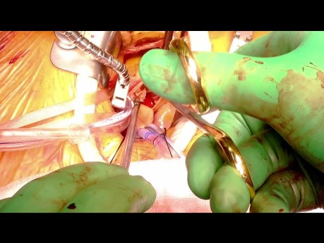 Aortic Valve Replacement via Right Anterior Thoracotomy. Avalus Prosthesis.