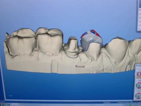 CEREC AC Axis of Insertion