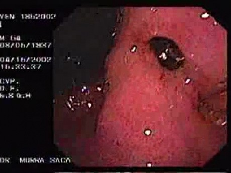 Zollinger- Ellison Syndrome - Gastric Ulcer with Gastrocolic Fistula (7 of 21)