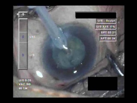 Cataract Surgery 2 - Part 2
