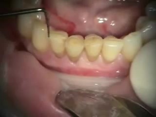 Immediate Provisional Bridge On Implants