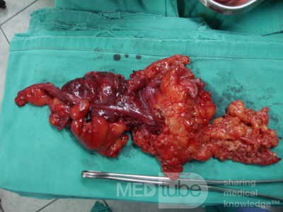 Severe case of Ischemic Colitis (13 of 19)