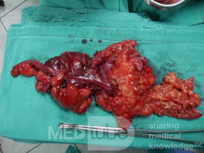 Severe case of Ischemic Colitis (13 of 19)