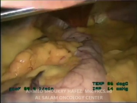 Laparoscopic Sleeve Gastrectomy for Morbid Obesity