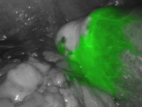 Anastomosis After Right Hemicolectomy ICG Perfusion Test